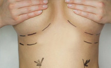 chirurgie plastique - Clinique Saint-Augustain