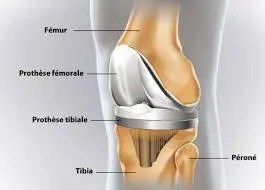 gonarthrose orthopédie Tunisie