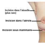 Cicatrices augmentation mammaire Tunisie