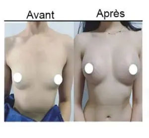 Augmentation mammaire Tunisie
