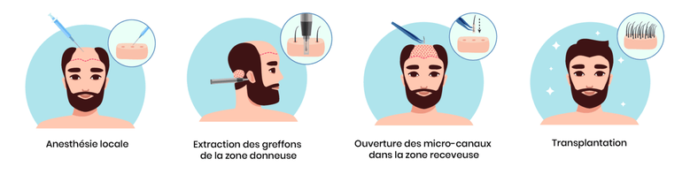 greffe cheveux Tunisie FUE